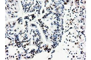 Immunohistochemical staining of paraffin-embedded Adenocarcinoma of Human breast tissue using anti-NT5DC1 mouse monoclonal antibody. (NT5DC1 Antikörper)