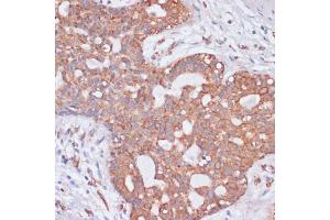 Immunohistochemistry of paraffin-embedded human breast cancer using KCNH2 antibody (ABIN3023435, ABIN3023436, ABIN3023437 and ABIN6219948) at dilution of 1:100 (40x lens). (KCNH2 Antikörper)