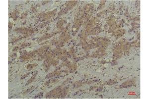 Immunohistochemistry (IHC) analysis of paraffin-embedded Human Breast Carcinoma using P44/42 MAPK (ERK1/2) Mouse Monoclonal Antibody diluted at 1:200. (ERK1/2 Antikörper)