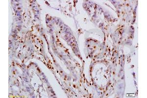 Formalin-fixed and paraffin embedded human colon carcinoma labeled with Rabbit Anti KLF4 Polyclonal Antibody, Unconjugated (ABIN737121) at 1:200 followed by conjugation to the secondary antibody and DAB staining (KLF2/4 Antikörper  (AA 415-513))
