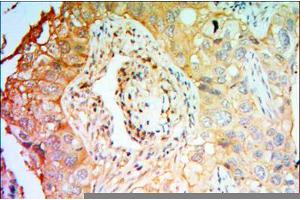 Immunohistochemical analysis of paraffin-embedded lung cancer tissues using PTK7 mouse mAb with DAB staining. (PTK7 Antikörper)