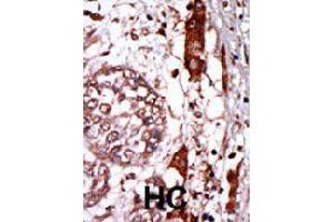 Formalin-fixed and paraffin-embedded human hepatocellular carcinoma tissue reacted with GNB2L1 polyclonal antibody  , which was peroxidase-conjugated to the secondary antibody, followed by AEC staining.