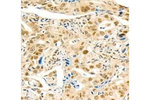 Immunohistochemistry of paraffin embedded human gastric cancer using MST1 (ABIN7075561) at dilution of 1: 1000 (400x lens) (STK4 Antikörper)