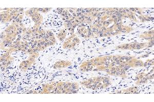 Detection of MAPK14 in Human Lung cancer Tissue using Polyclonal Antibody to Mitogen Activated Protein Kinase 14 (MAPK14) (MAPK14 Antikörper  (AA 19-279))
