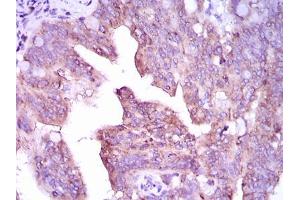 Immunohistochemical analysis of paraffin-embedded rectum cancer tissues using CAMK4 mouse mAb with DAB staining.