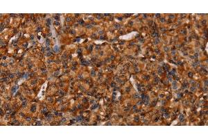Immunohistochemistry of paraffin-embedded Human prostate cancer tissue using COL18A1 Polyclonal Antibody at dilution 1:40 (COL18A1 Antikörper)