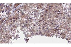 ABIN6277415 at 1/100 staining Human liver cancer tissue by IHC-P. (NFASC Antikörper  (C-Term))