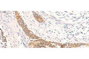 Immunohistochemistry of paraffin-embedded Human esophagus cancer tissue using HSPA4L Polyclonal Antibody at dilution of 1:30(x200) (HSPA4L Antikörper)