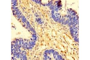 Immunohistochemistry of paraffin-embedded human ovarian cancer using ABIN7174393 at dilution of 1:100 (OTUB1 Antikörper  (AA 2-201))