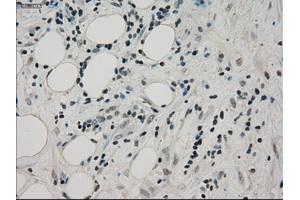 Immunohistochemical staining of paraffin-embedded Adenocarcinoma of colon tissue using anti-PPP1R7mouse monoclonal antibody.