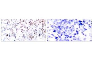 Immunohistochemical analysis of paraffin-embedded human breast carcinoma tissue using Myc (phospho- Thr358) antibody (E011035). (c-MYC Antikörper  (pThr358))