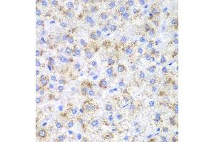 Immunohistochemistry of paraffin-embedded human liver cancer using HAO1 antibody (ABIN5973868) at dilution of 1/200 (40x lens). (HAO1 Antikörper)