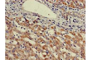 Immunohistochemistry of paraffin-embedded human liver cancer using ABIN7174571 at dilution of 1:100 (ube3a Antikörper  (AA 83-234))