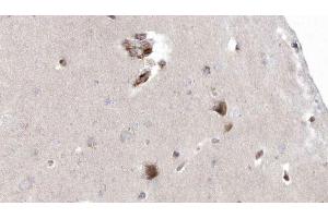 ABIN6272926 at 1/100 staining Human brain cancer tissue by IHC-P. (OXCT1 Antikörper  (Internal Region))