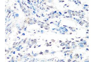 Immunohistochemistry of paraffin-embedded human lung cancer using MTA2 Antibody (ABIN5998268) at dilution of 1/100 (40x lens). (MTA2 Antikörper)