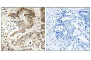 Immunohistochemistry analysis of paraffin-embedded human colon carcinoma tissue using PIK3R5 antibody. (PIK3R5 Antikörper)