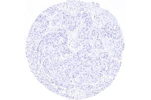 Complete absence of arginase 1 immunostaining in a cholangiocellular carcinoma of the liver (Rekombinanter Liver Arginase Antikörper  (AA 300-400))