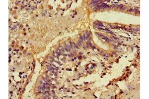 Immunohistochemistry of paraffin-embedded human lung cancer using ABIN7146326 at dilution of 1:100
