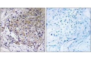 Immunohistochemistry analysis of paraffin-embedded human breast carcinoma tissue, using WASF3 Antibody. (WASF3 Antikörper  (AA 151-200))