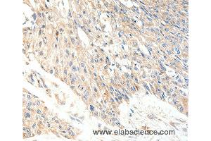 Immunohistochemistry of Human lung cancer using SLC27A1 Polyclonal Antibody at dilution of 1:40 (SLC27A1 Antikörper)