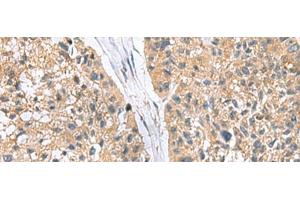 Immunohistochemistry of paraffin-embedded Human esophagus cancer tissue using RGS2 Polyclonal Antibody at dilution of 1:95(x200) (RGS2 Antikörper)