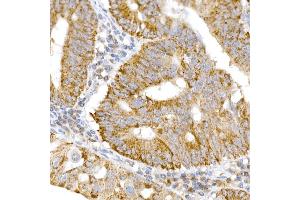 Immunohistochemistry of paraffin-embedded human colon carcinoma using GM130 antibody (ABIN6129789, ABIN6141264, ABIN6141265 and ABIN6220979) at dilution of 1:25 (40x lens).