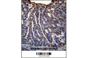 HOXB3 Antibody immunohistochemistry analysis in formalin fixed and paraffin embedded human ovarian carcinoma followed by peroxidase conjugation of the secondary antibody and DAB staining. (HOXB3 Antikörper  (AA 119-148))