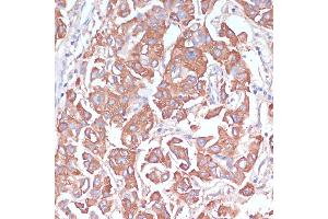 Immunohistochemistry of paraffin-embedded human liver cancer using LRP1 antibody (ABIN3021968, ABIN3021969, ABIN3021970 and ABIN6218530) at dilution of 1:100 (40x lens). (LRP1 Antikörper  (AA 20-270))