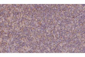 ABIN6273131 at 1/100 staining Human lymph cancer tissue by IHC-P. (KIFC3 Antikörper  (C-Term))