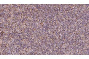 ABIN6273131 at 1/100 staining Human lymph cancer tissue by IHC-P. (KIFC3 Antikörper  (C-Term))