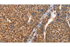 Immunohistochemistry of paraffin-embedded Human liver cancer tissue using ANGPTL1 Polyclonal Antibody at dilution 1:40 (ANGPTL1 Antikörper)