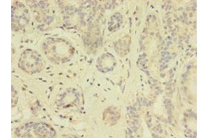 Immunohistochemistry of paraffin-embedded human breast cancer using ABIN7172114 at dilution of 1:100 (TK1 Antikörper  (AA 2-234))