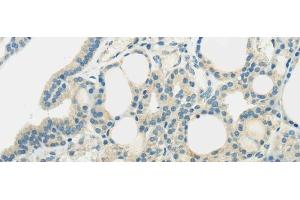 Immunohistochemistry of paraffin-embedded Human thyroid cancer using SLC7A11 Polyclonal Antibody at dilution of 1/35 (SLC7A11 Antikörper)