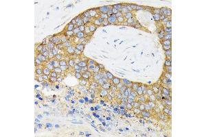 Immunohistochemistry of paraffin-embedded human esophageal cancer using RPS3 Rabbit pAb (ABIN3023342, ABIN3023343, ABIN3023344 and ABIN6219623) at dilution of 1:100 (40x lens). (RPS3 Antikörper  (AA 1-243))