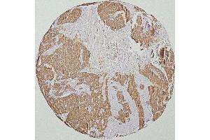 human head and neck squamous-cell carcinoma (HNSCC)(courtesy of J. (Cytokeratin 19 Antikörper)