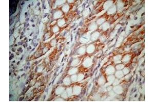 Human colon cancer tissue was stained by Rabbit Anti-GLP-1 (12-24) (Human) Antibody (GLP-1 Antikörper  (AA 12-24))