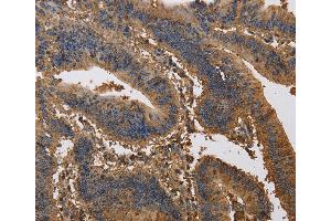 Immunohistochemistry of Human liver cancer using KCNG1 Polyclonal Antibody at dilution of 1:40 (KCNG1 Antikörper)