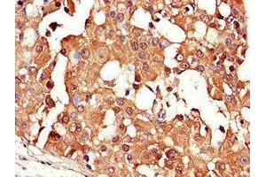 Immunohistochemistry of paraffin-embedded human breast cancer using ABIN7147342 at dilution of 1:100 (CRABP2 Antikörper  (AA 1-138))