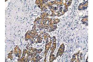 ABIN6258567 and ABIN6276236 at 1/100 staining human colorectal cancer by IHC-P. (VN1R2 Antikörper  (Internal Region))