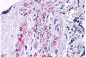 Human Placenta (formalin-fixed, paraffin-embedded) stained with ADAMTS5 antibody ABIN625839 at 14 ug/ml followed by biotinylated goat anti-rabbit IgG secondary antibody ABIN481713, alkaline phosphatase-streptavidin and chromogen. (ADAMTS5 Antikörper  (N-Term))