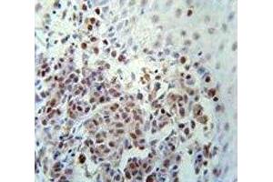 XRCC1 antibody immunohistochemistry analysis in formalin fixed and paraffin embedded human skin carcinoma. (XRCC1 Antikörper  (AA 407-435))