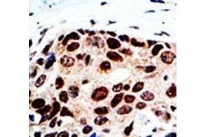 IHC analysis of FFPE human breast cancer tissue stained with the HDAC9 antibody (HDAC9 Antikörper  (AA 503-533))