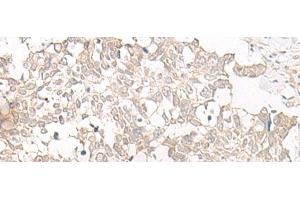 Immunohistochemistry of paraffin-embedded Human lung cancer tissue using ESPN Polyclonal Antibody at dilution of 1:25(x200) (Espin Antikörper)