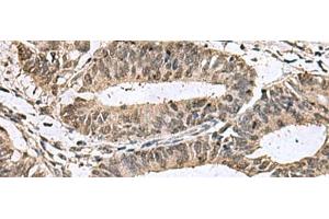 Immunohistochemistry of paraffin-embedded Human colorectal cancer tissue using TMX3 Polyclonal Antibody at dilution of 1:70(x200) (TMX3 Antikörper)