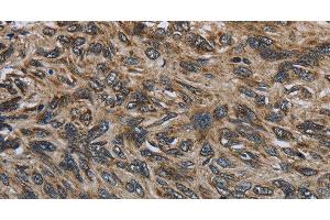 Immunohistochemistry of paraffin-embedded Human esophagus cancer tissue using CD236 Polyclonal Antibody at dilution 1:60 (CD236/GYPC Antikörper)