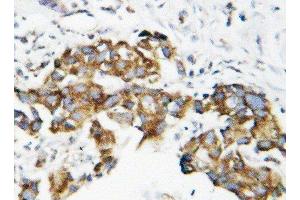 Anti-Superoxide Dismutase 1 antibody, IHC(P) IHC(P): Human Mammary Cancer Tissue (SOD1 Antikörper  (C-Term))