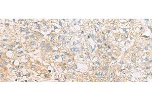 Immunohistochemistry of paraffin-embedded Human liver cancer tissue using EIF4E2 Polyclonal Antibody at dilution of 1:50(x200) (EIF4E2 Antikörper)
