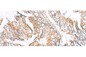 Immunohistochemistry of paraffin-embedded Human colorectal cancer tissue using GPC2 Polyclonal Antibody at dilution of 1:40(x200) (GPC2 Antikörper)