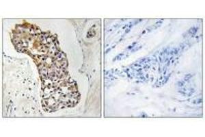 Immunohistochemistry analysis of paraffin-embedded human breast carcinoma tissue, using HSD11B1 antibody. (HSD11B1 Antikörper  (N-Term))