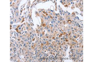 Immunohistochemistry of Human cervical cancer using NRG4 Polyclonal Antibody at dilution of 1:60 (Neuregulin 4 Antikörper)